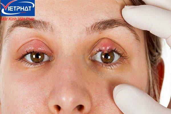 Mụn lẹo ở mắt | 7+ cách trị mụn lẹo ở mắt nhanh nhất 7 cách trị mụn lẹo ở mắt