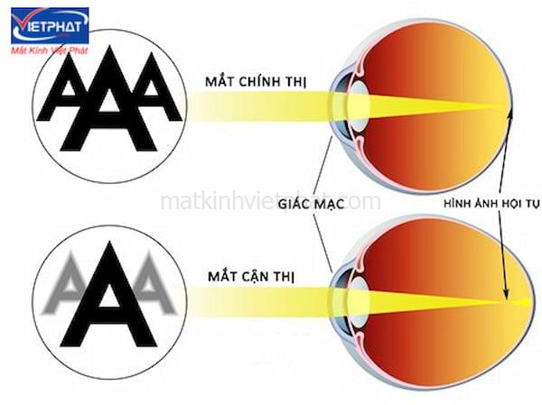 So sánh cận thị và viễn thị: Nguyên nhân và cách khắc phục 7 so sánh cận thị và viễn thị