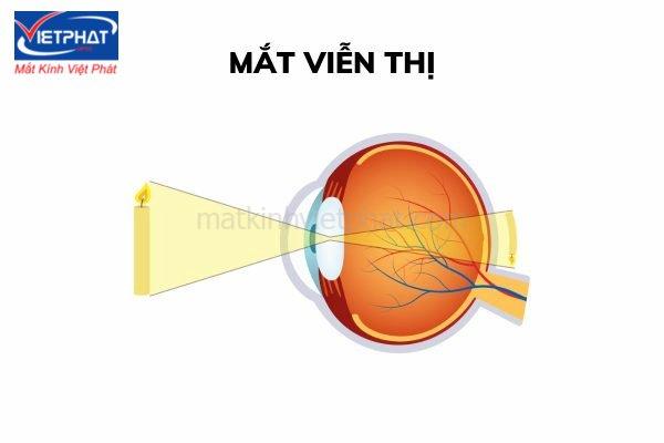 So sánh cận thị và viễn thị: Nguyên nhân và cách khắc phục 8 so sánh cận thị và viễn thị