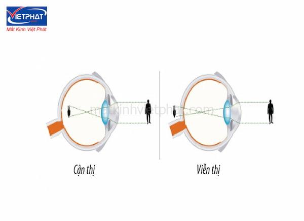 So sánh cận thị và viễn thị: Nguyên nhân và cách khắc phục 9 sự khác nhau giữa cận thị và viễn thị