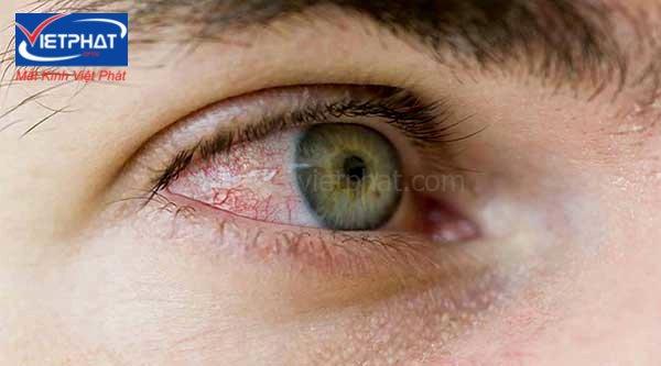 9 triệu chứng bệnh về mắt nguy hiểm thường gặp 10 triệu chứng bệnh về mắt