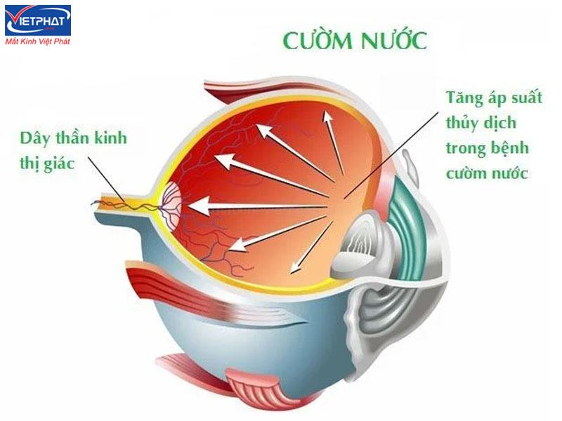 Bệnh cườm nước có nguy hiểm không? Nguyên nhân và cách điều trị 8 Bệnh cườm nước là gì?