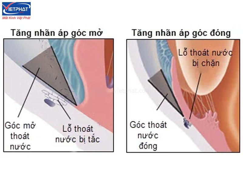 Bệnh cườm nước có nguy hiểm không? Nguyên nhân và cách điều trị 10 Bệnh cườm nước góc mở là gì