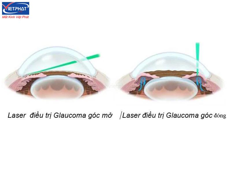 Bệnh cườm nước có nguy hiểm không? Nguyên nhân và cách điều trị 13 Phương pháp điều trị bệnh Glaucoma