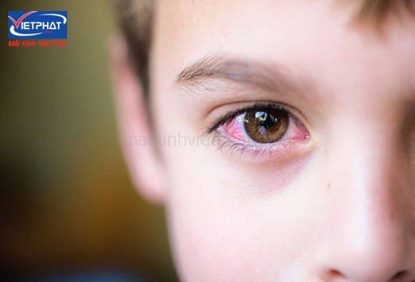 15 bệnh về mắt ở trẻ em thường gặp mà bạn cần lưu ý 13 Viêm kết mạc
