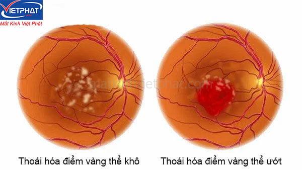6 bệnh về mắt ở người già thường gặp bạn cần biết 6 các bệnh về mắt ở người già