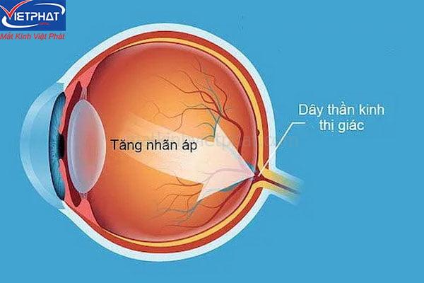 6 bệnh về mắt ở người già thường gặp bạn cần biết 7 các bệnh về mắt ở người già