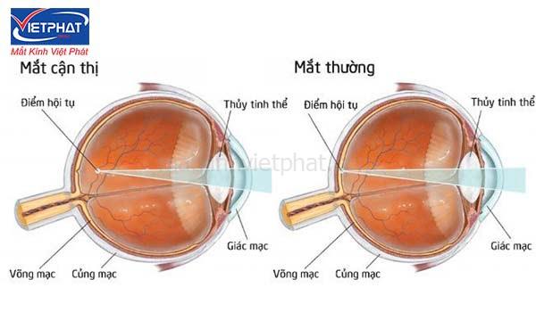 Cận thị là gì? Các loại cận thị thường gặp 7 các loại cận thị
