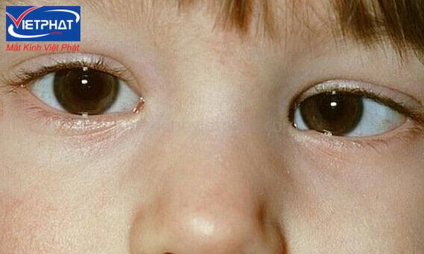 Cận lệch độ, bất đồng khúc xạ là gì? Nguy cơ và cách chữa 9 mắt cận lệch