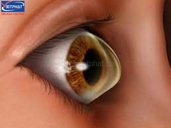 Cận nặng có mổ được không? 7 điều cần lưu ý trước khi mổ cận 10 Hình dạng của giác mạc ảnh hưởng lớn đến kết quả mổ cận