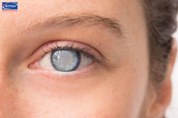 Bệnh cườm khô là gì? Cườm khô có nguy hiểm không? 9 cườm khô