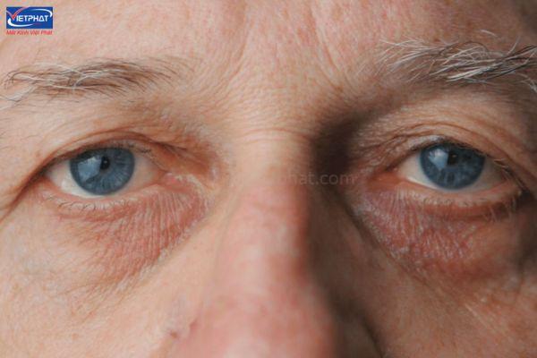 Bệnh cườm khô là gì? Cườm khô có nguy hiểm không? 10 cườm khô