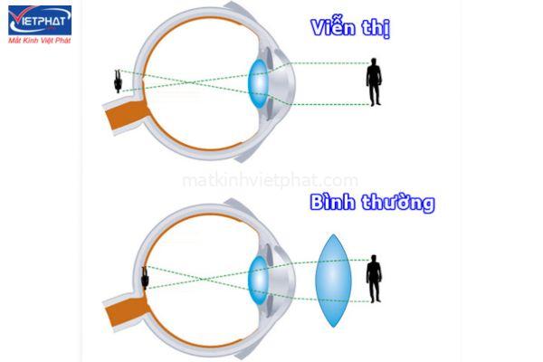 Cách phân biệt lão thị và viễn thị? 8 Nguyên nhân chính gây ra viễn thị là do nhãn cầu quá ngắn hoặc giác mạc dẹt