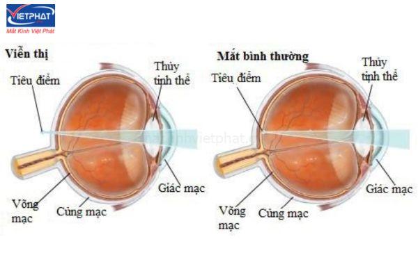 Cách phân biệt lão thị và viễn thị? 9 Viễn thị có thể ảnh hưởng ở mọi lứa tuổi và thường có tính di truyền