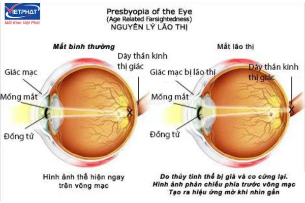 Cách phân biệt lão thị và viễn thị? 10 Lão thị thường bắt đầu từ khoảng 40 tuổi