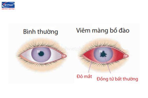 Mắt nhìn xa bị mờ, nhòe - Nguyên nhân do đâu? 9 mắt nhìn xa bị mờ