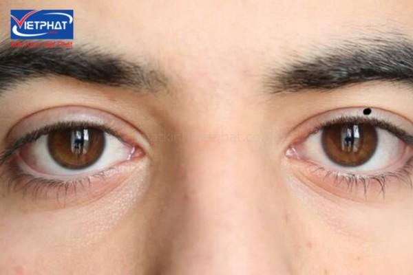Nốt ruồi trong mắt là tốt hay xấu? Có nên xóa không? 12 có nốt ruồi trong mắt