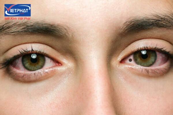 Nốt ruồi trong mắt là tốt hay xấu? Có nên xóa không? 13 có nốt ruồi trong mắt