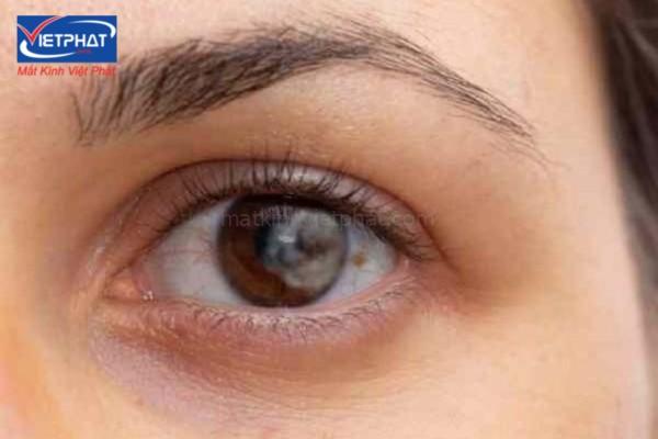 Nốt ruồi trong mắt là tốt hay xấu? Có nên xóa không? 10 nốt ruồi trong mắt