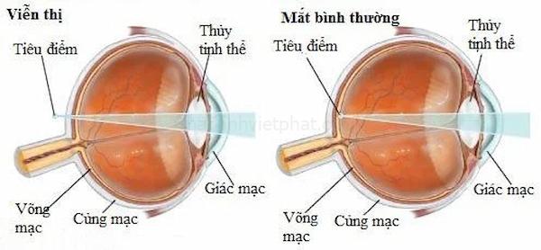 Mắt bị viễn thị - Nguyên nhân, dấu hiệu và cách phòng ngừa 12 Nguyên nhân gây ra viễn thị ở mắt