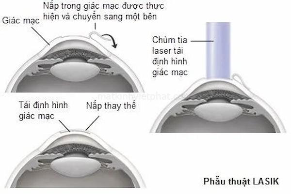 Mắt bị viễn thị - Nguyên nhân, dấu hiệu và cách phòng ngừa 15 Hình 6. Phương pháp phẫu thuật Lasik cho mắt bị viễn thị