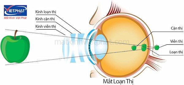 Cận loạn thị là gì? Cận loạn có mổ được không? 9 cận loạn có mổ được không