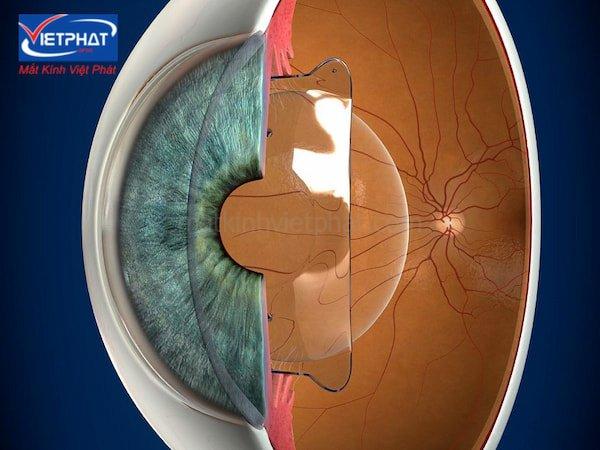 Cận loạn thị là gì? Cận loạn có mổ được không? 14 cận loạn có mổ được không