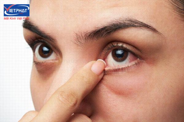 Hiện tượng chớp mắt liên tục có nguy hiểm hông? 9 Mắt bị mỏi và chớp liên tục