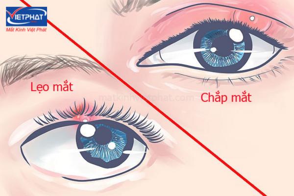 Mụn trắng nổi ở mí mắt là bị gì? Có nguy hiểm không? 9 mụn trắng nổi ở mí mắt