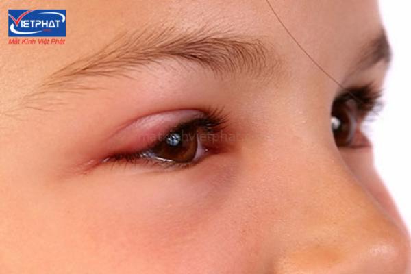 Mụn trắng nổi ở mí mắt là bị gì? Có nguy hiểm không? 10 mí mắt trên nổi mụn trắng nhỏ