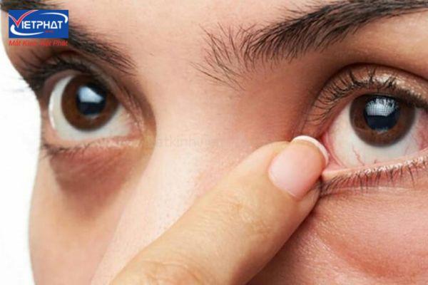 Mụn trắng nổi ở mí mắt là bị gì? Có nguy hiểm không? 13 mọc mụn trắng ở mí mắt dưới
