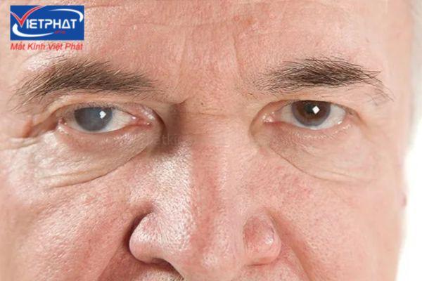 3 cách hạ nhãn áp phổ biến, hiệu quả nhất hiện nay 7 cách hạ nhãn áp