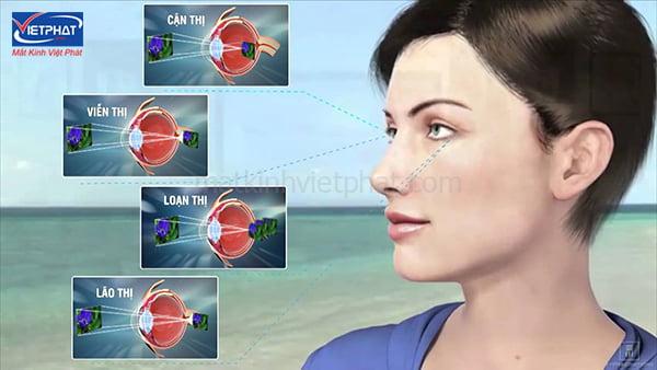 7 Cách làm mắt hết mờ, giảm mệt mỏi, đau mắt hiệu quả ngay tại nhà 11 Các tật khúc xạ về mắt