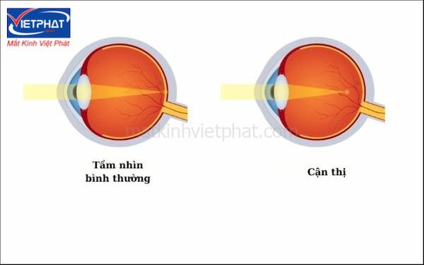 Cận thị có chữa được không? 6 phương pháp chữa cận thị tốt nhất 9 cận thị có chữa được không