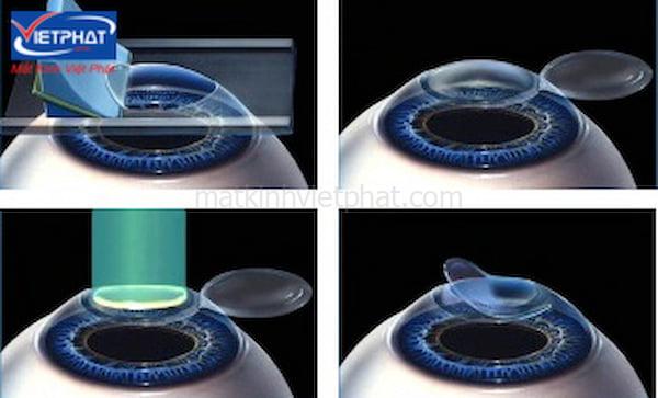 Cận thị có chữa được không? 6 phương pháp chữa cận thị tốt nhất 14 cận thị có chữa được không