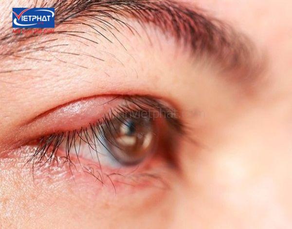 7 Cách khắc phục đeo kính áp tròng bị cay mắt 11 đeo kính áp tròng bị cay mắt