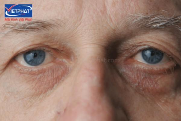 Đục thủy tinh thể ở người già có nguy hiểm không? 9 bệnh đục thủy tinh thể