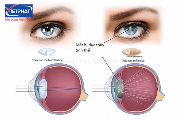 bệnh đục thủy tinh thể