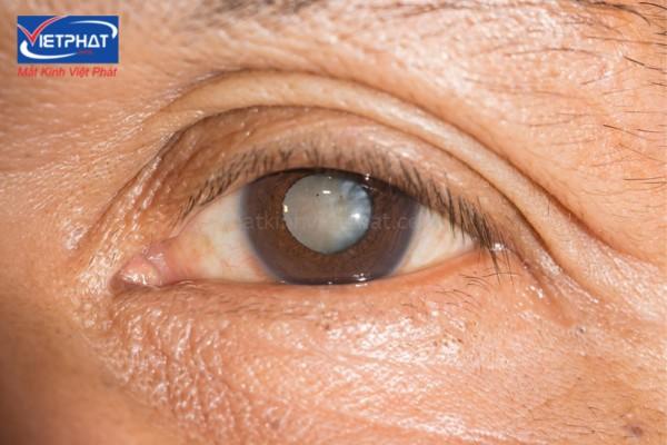Đục thủy tinh thể ở người già có nguy hiểm không? 11 mắt bị đục thủy tinh thể
