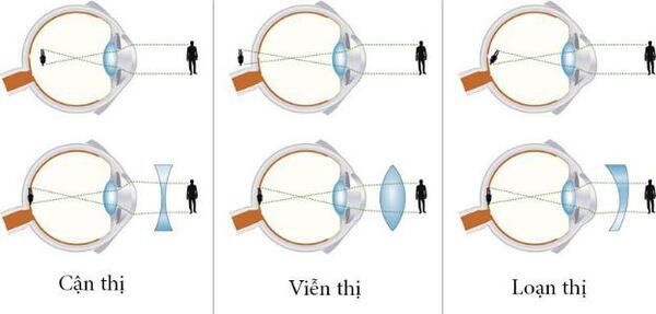 Kính Thuốc Là Gì? Cẩm Nang Về Kính Thuốc Từ A-Z