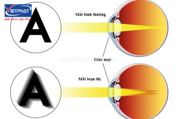 Loạn thị bao nhiêu độ là nặng? Bị loạn cao nhất là bao nhiêu độ? 7 loạn thị bao nhiêu độ là nặng