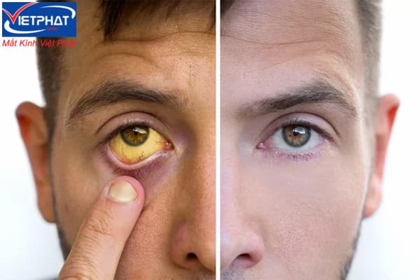 Lòng trắng mắt bị vàng là gì? Cách chữa lòng trắng mắt bị vàng 11 Lòng trắng mắt bị vàng