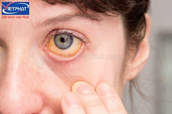 Lòng trắng mắt bị vàng là gì? Cách chữa lòng trắng mắt bị vàng 9 Lòng trắng mắt vàng mắt do sử dụng thuốc