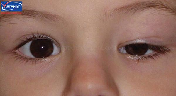 Mắt to mắt nhỏ là gì? Top 3 cách khắc phục mắt to mắt nhỏ tại nhà 10 Mắt to mắt nhỏ do di truyền, bẩm sinh