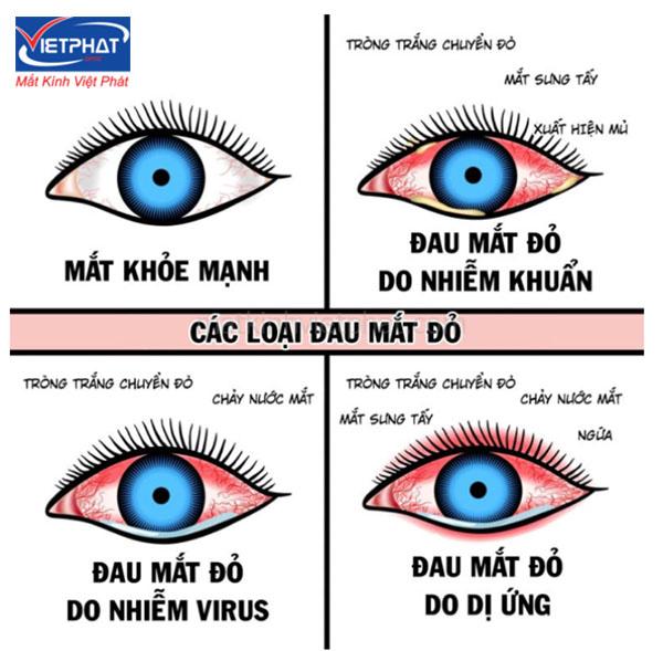 4 mẹo chữa đau mắt đỏ nhanh nhất tại nhà 9 Bệnh đau mắt đỏ hay viêm kết mạc cấp tính