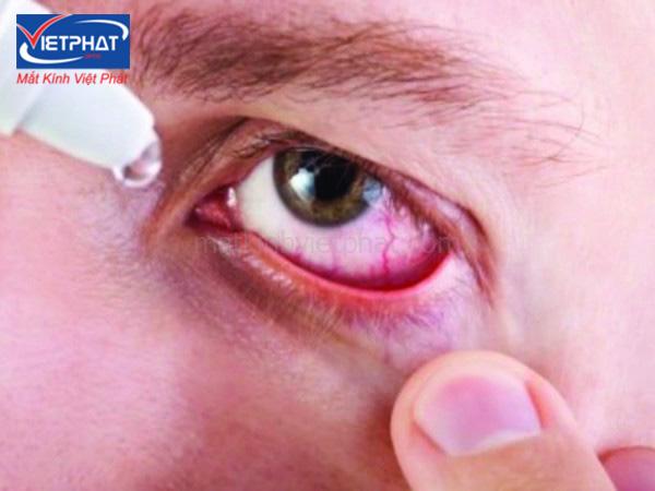4 mẹo chữa đau mắt đỏ nhanh nhất tại nhà 10 Mẹo chữa đau mắt đỏ nhanh nhất tại nhà bằng thuốc nhỏ mắt