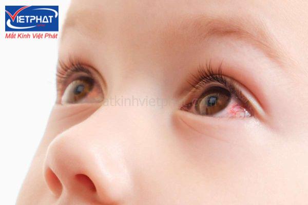 4 mẹo chữa đau mắt đỏ nhanh nhất tại nhà 13 Mẹo chữa đau mắt đỏ nhanh nhất cần phải hiểu cách áp dụng đúng cách