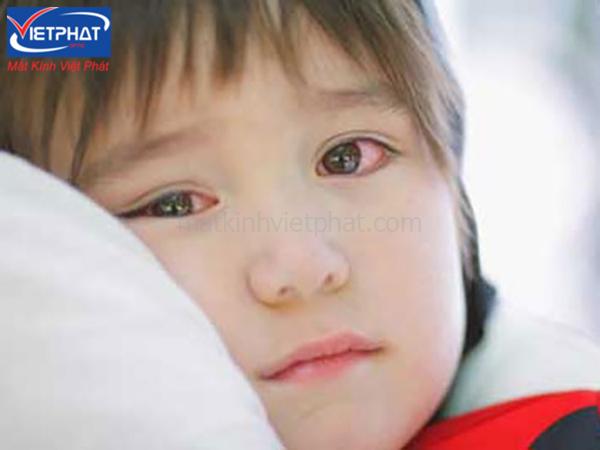 4 mẹo chữa đau mắt đỏ nhanh nhất tại nhà 15 Mẹo chữa đau mắt đỏ nhanh nhất tại nhà