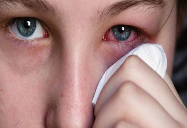 Ngứa Mắt Trái: Điềm Báo, Nguyên Nhân Và Cách Trị 6 Ngứa mắt trái