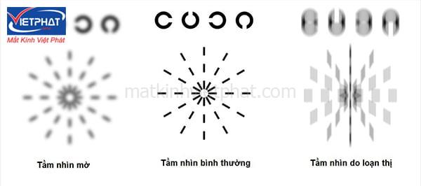 Loạn thị có tăng độ không? Nguyên nhân tăng độ loạn thị 9 Loạn thị nặng khiến mắt không tập trung vào một điểm ở võng mạc
